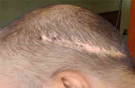 Failed Hair Transplant Repair