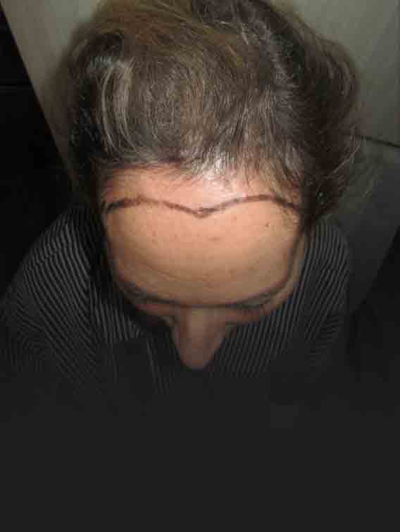 Female Pattern Baldness