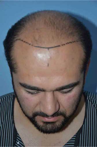 Hairline Reconstruction