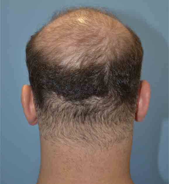 Male Pattern Baldness