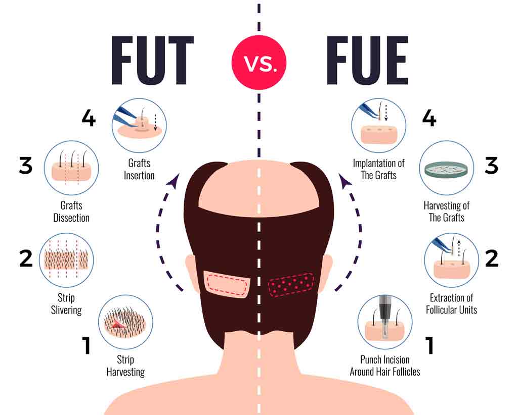 hair transplant fue