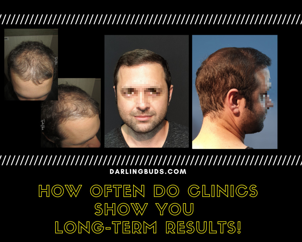 Hair transplant