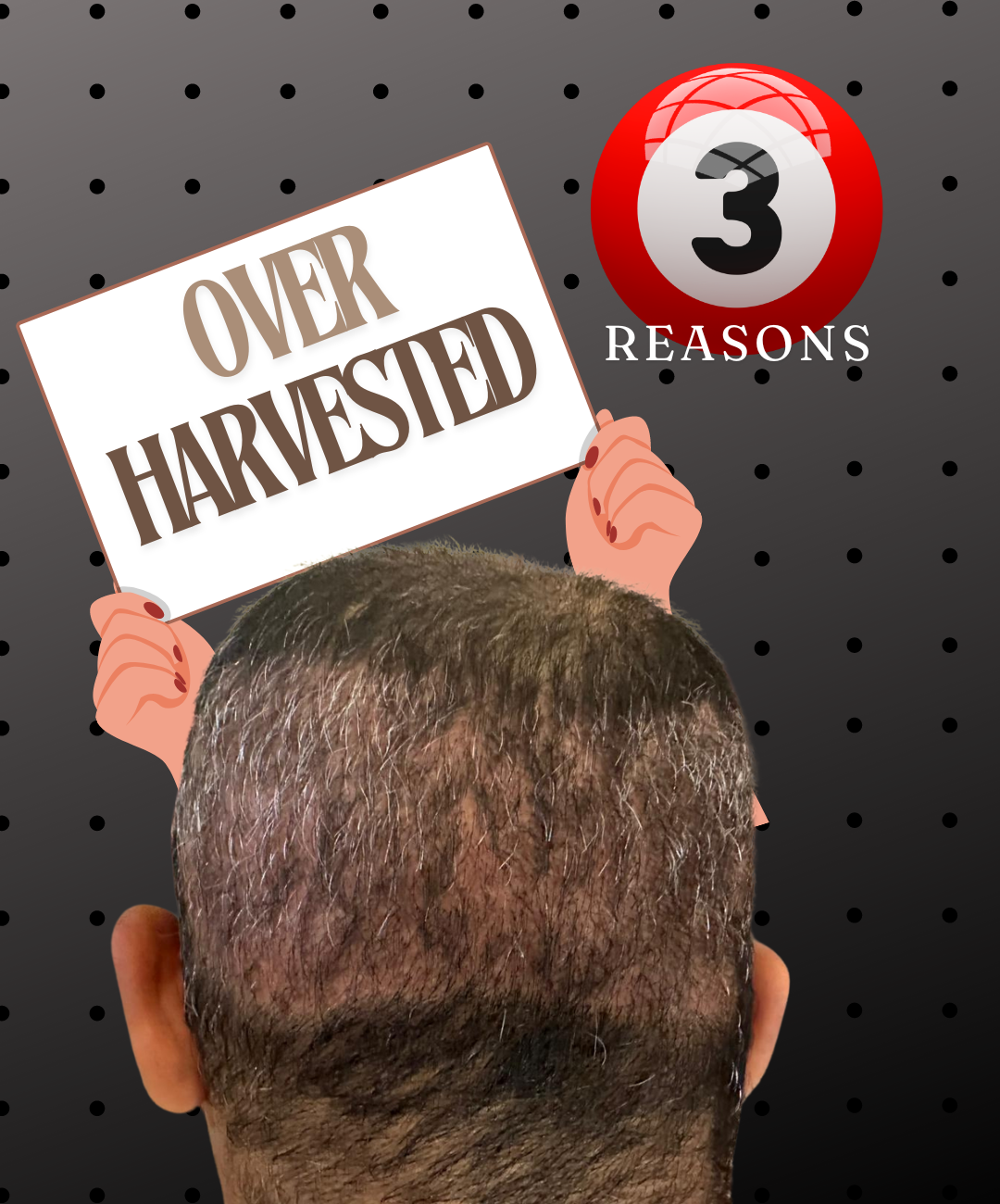 3 Reasons why Overharvesting & Scarring happen in the Scalp Donor after Hair Transplant !