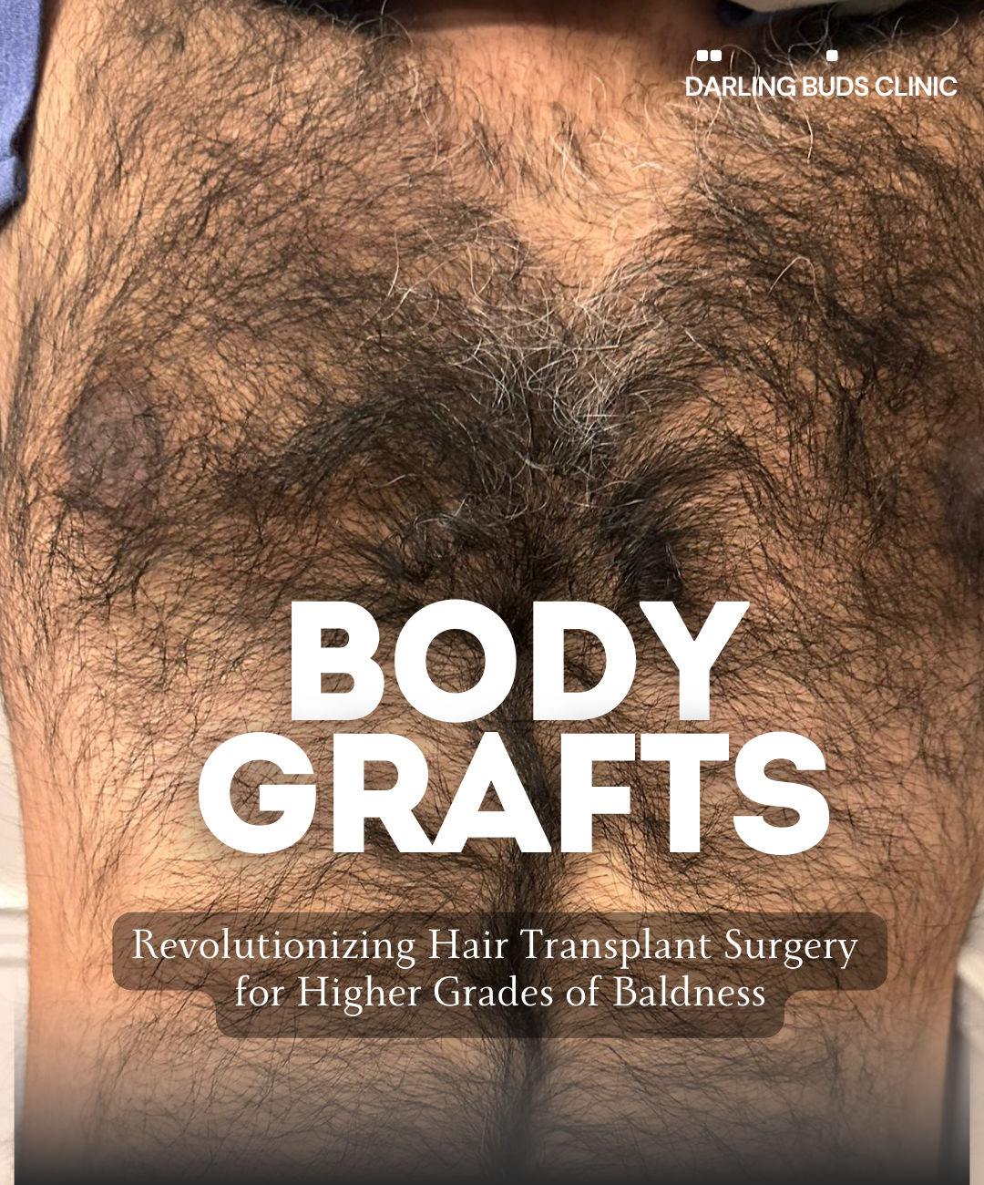 Revolutionizing Hair Transplant Surgery for Higher Grades of Baldness