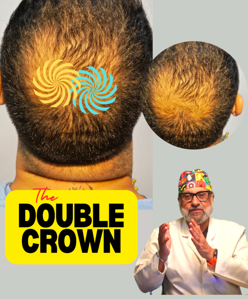 Double Crown Hair Transplant